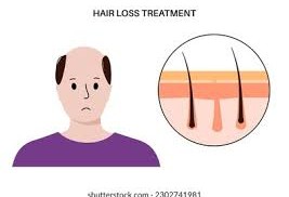 Understanding Androgenetic Alopecia (Male Pattern Baldness)